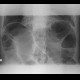 Large bowel ileus: X-ray - Plain radiograph