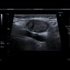 Lateral cervical cyst, complicated: US - Ultrasound