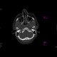 Le Fort II, fracture of facial skeleton: CT - Computed tomography