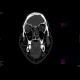 Le Fort II, fracture of facial skeleton: CT - Computed tomography