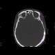 Fracture of facial skeleton, Le Fort III: CT - Computed tomography