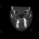Fracture of facial skeleton, Le Fort III: CT - Computed tomography