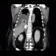 Leak of anastomosis of esophagus in pleural cavity, gastroesophageal anastomosis: CT - Computed tomography