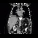 Leak of anastomosis of esophagus in pleural cavity, gastroesophageal anastomosis: CT - Computed tomography