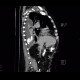 Leak of anastomosis of esophagus in pleural cavity, gastroesophageal anastomosis: CT - Computed tomography