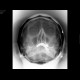 Chronic sinusitis, maxillary sinus, left side: X-ray - Plain radiograph