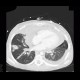 Aspergilosis of the lung, pericardial effusion, mediastinal lymphoma: CT - Computed tomography