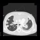 Aspergilosis of the lung, pericardial effusion, mediastinal lymphoma: CT - Computed tomography