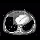 Aspergilosis of the lung, pericardial effusion, mediastinal lymphoma: CT - Computed tomography