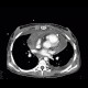 Aspergilosis of the lung, pericardial effusion, mediastinal lymphoma: CT - Computed tomography