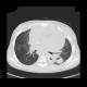 Aspergilosis of the lung, pericardial effusion, mediastinal lymphoma: CT - Computed tomography