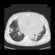 Aspergilosis of the lung, pericardial effusion, mediastinal lymphoma: CT - Computed tomography