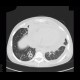 Aspergilosis of the lung, pericardial effusion, mediastinal lymphoma: CT - Computed tomography