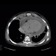 Aspergilosis of the lung, pericardial effusion, mediastinal lymphoma: CT - Computed tomography