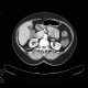 Lipoma of duodenum: CT - Computed tomography