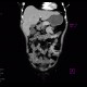 Lipoma of duodenum: CT - Computed tomography