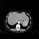 Lipoma of the liver: CT - Computed tomography