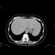 Lipoma of the liver: CT - Computed tomography