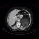 Liposarcoma, retroperitoneal: CT - Computed tomography