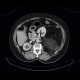 Liposarcoma, retroperitoneal: CT - Computed tomography