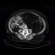 Liposarcoma, retroperitoneal: CT - Computed tomography