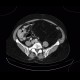 Liposarcoma, retroperitoneal: CT - Computed tomography