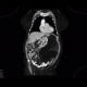 Liposarcoma, retroperitoneal: CT - Computed tomography