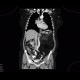 Liposarcoma, retroperitoneal: CT - Computed tomography