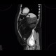 Liposarcoma, retroperitoneal: CT - Computed tomography