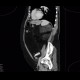 Liposarcoma, retroperitoneal: CT - Computed tomography