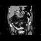 Liposarcoma of mesentery: CT - Computed tomography