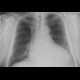 Lobus venae azygos: X-ray - Plain radiograph
