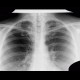 Lobus venae azygos, azygous vein lobe: X-ray - Plain radiograph