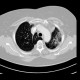 Lobus venae azygos, azygous lobe: CT - Computed tomography