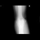 Osseous bridging of the left elbow: X-ray - Plain radiograph