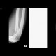 Osseous bridging of the left elbow: X-ray - Plain radiograph