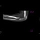 Osseous bridging of the left elbow: CT - Computed tomography