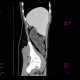 CT enterography, low-dose: CT - Computed tomography