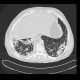 _fetch_thumbnail.php?img=Lung%20tuberculosis,%20HRCT.CT.4_0001.JPG