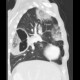Lung abscess: CT - Computed tomography