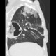 Lung abscess: CT - Computed tomography