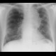 Lung carcinoma, metastasis: X-ray - Plain radiograph