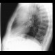 Lung carcinoma, metastasis: X-ray - Plain radiograph