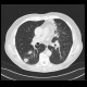 Lung carcinoma, metastasis: CT - Computed tomography