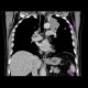 Lung carcinoma, metastasis: CT - Computed tomography