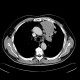 Lung carcinoma, metastasis: CT - Computed tomography