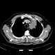 Lung carcinoma, metastasis: CT - Computed tomography