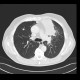 Lung carcinoma, metastasis: CT - Computed tomography