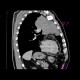 Lung carcinoma, metastasis: CT - Computed tomography