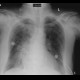 Lung congestion, interstitial edema: CT - Computed tomography